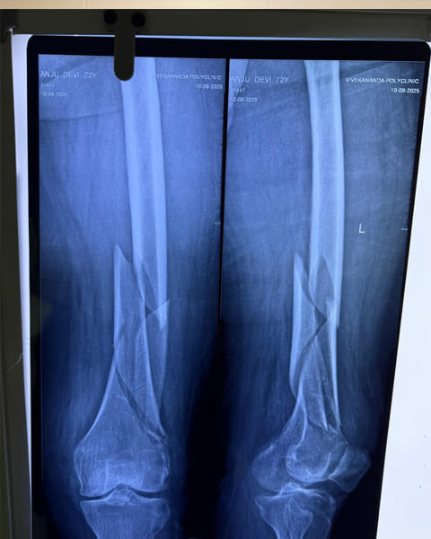 Shoulder Dislocation