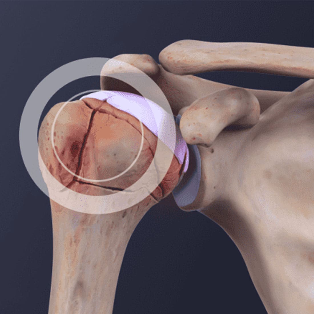 shoulder-fracture