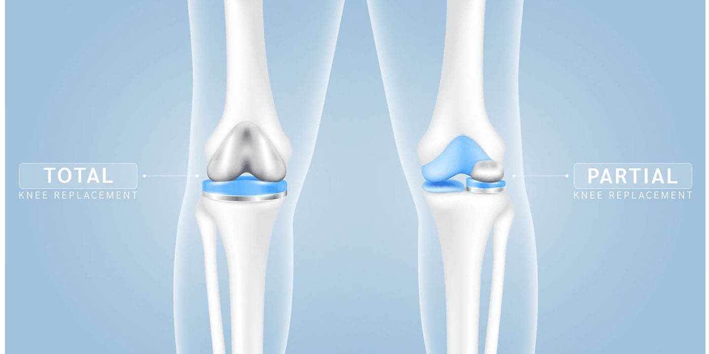 partial-knee-replacement