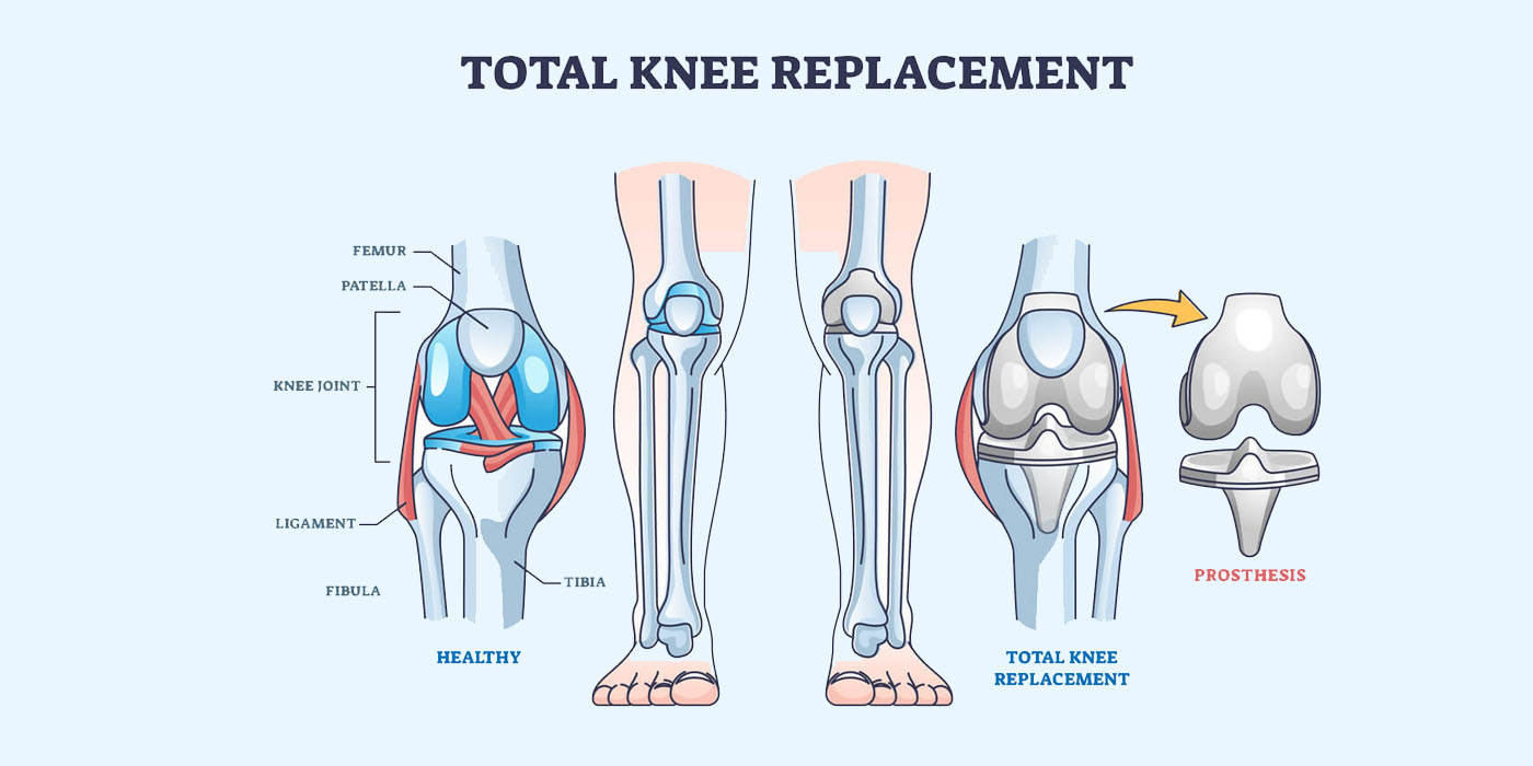 total-knee-replacement